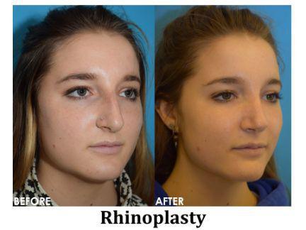 Rhinoplasty Before & After Image
