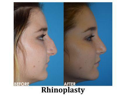 Rhinoplasty Before & After Image