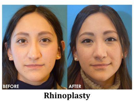 Rhinoplasty Before & After Image