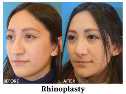 Rhinoplasty Before & After Image