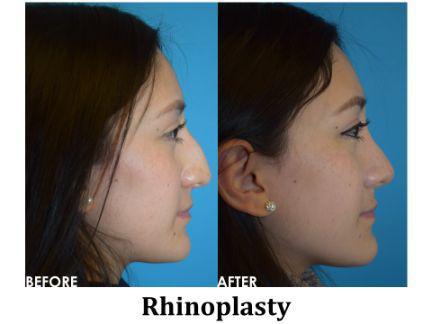 Rhinoplasty Before & After Image