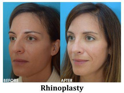 Rhinoplasty Before & After Image