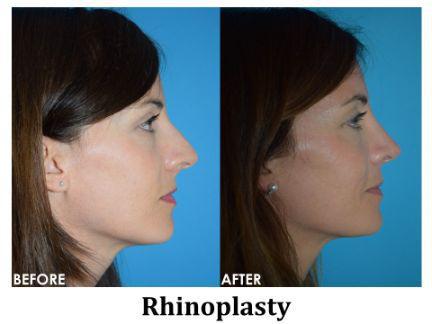 Rhinoplasty Before & After Image