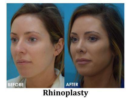 Rhinoplasty Before & After Image