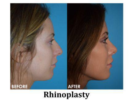 Rhinoplasty Before & After Image