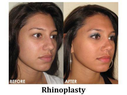 Rhinoplasty Before & After Image