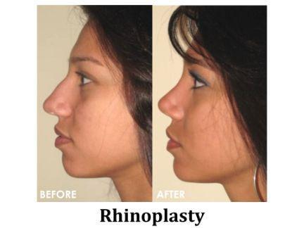 Rhinoplasty Before & After Image