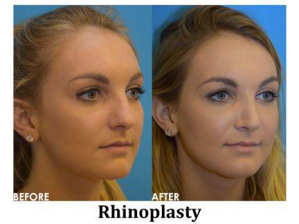 Rhinoplasty Before & After Image