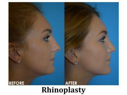 Rhinoplasty Before & After Image