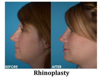 Rhinoplasty Before & After Image