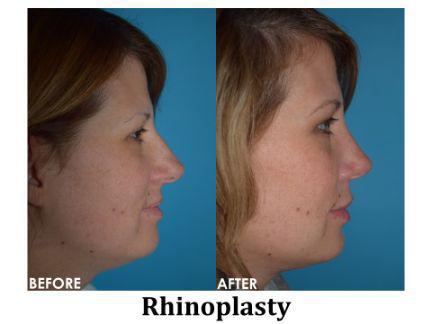 Rhinoplasty Before & After Image