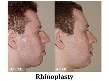 Rhinoplasty Before & After Image
