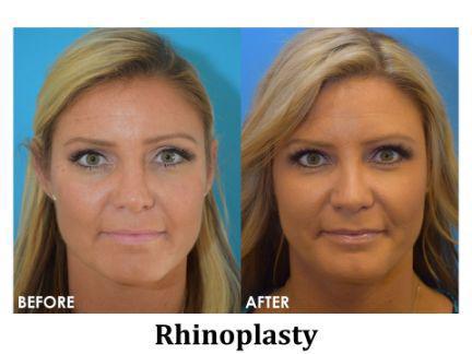 Rhinoplasty Before & After Image