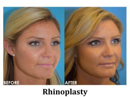 Rhinoplasty Before & After Image