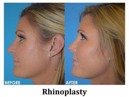 Rhinoplasty Before & After Image