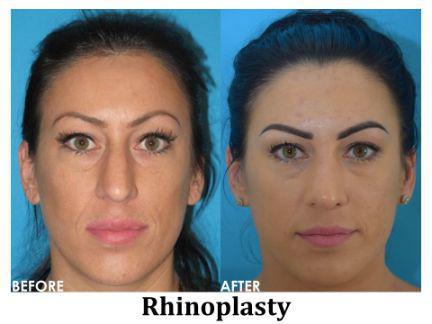 Rhinoplasty Before & After Image