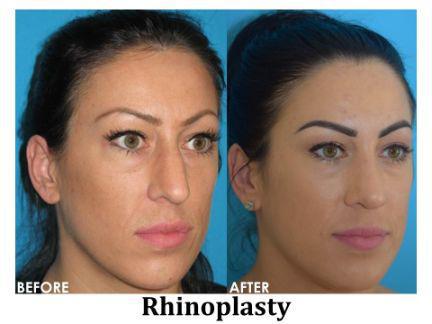 Rhinoplasty Before & After Image