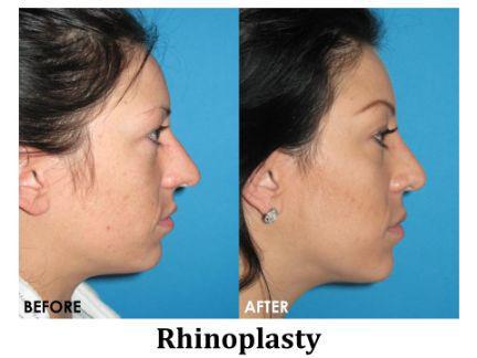 Rhinoplasty Before & After Image