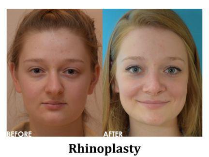 Rhinoplasty Before & After Image