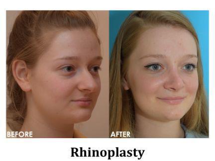 Rhinoplasty Before & After Image