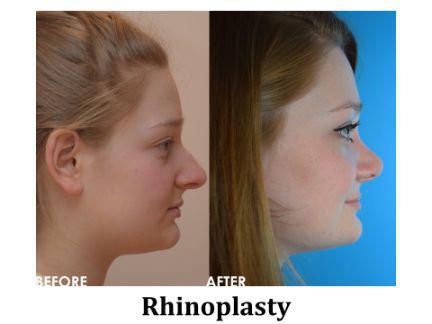 Rhinoplasty Before & After Image