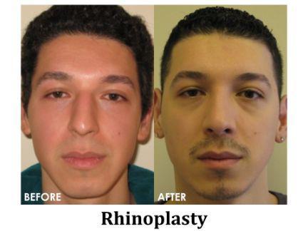 Rhinoplasty Before & After Image