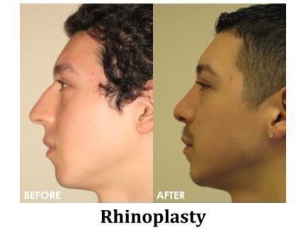 Rhinoplasty Before & After Image