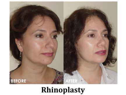 Rhinoplasty Before & After Image