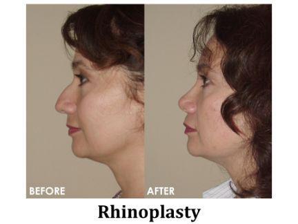 Rhinoplasty Before & After Image