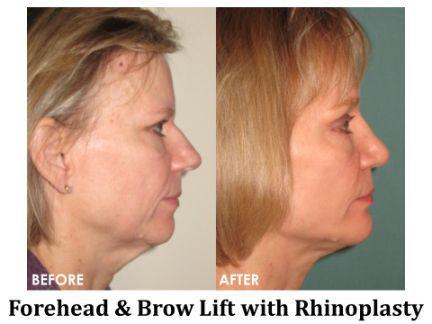 Rhinoplasty Before & After Image
