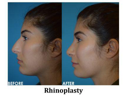 Rhinoplasty Before & After Image