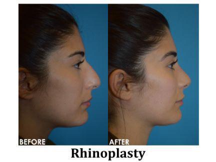 Rhinoplasty Before & After Image