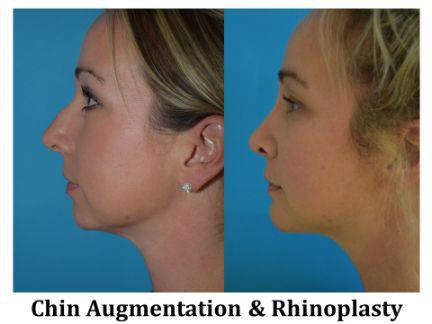 Rhinoplasty Before & After Image
