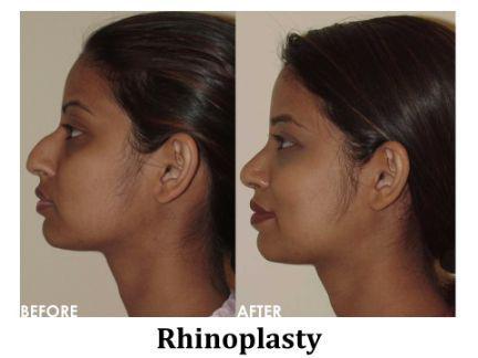 Rhinoplasty Before & After Image