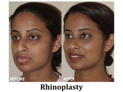 Rhinoplasty Before & After Image