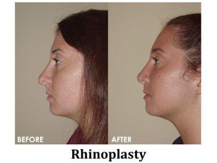 Rhinoplasty Before & After Image