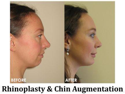 Rhinoplasty Before & After Image