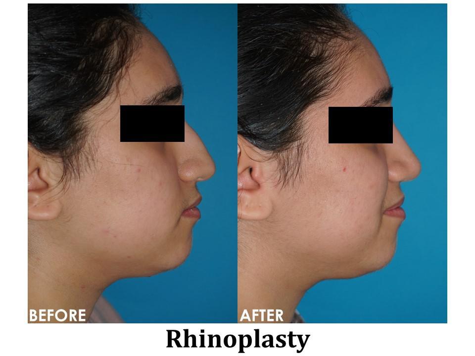 Rhinoplasty Before & After Image