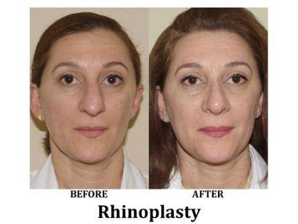 Rhinoplasty Before & After Image