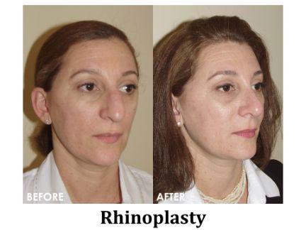 Rhinoplasty Before & After Image