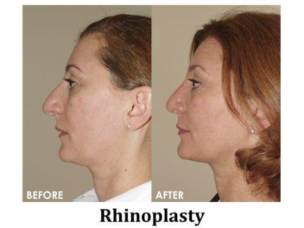 Rhinoplasty Before & After Image