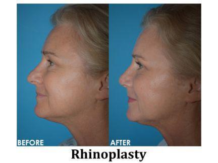 Rhinoplasty Before & After Image