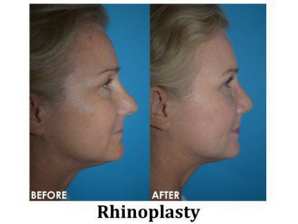 Rhinoplasty Before & After Image
