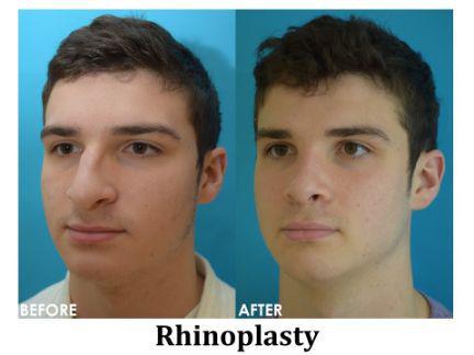 Rhinoplasty Before & After Image