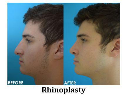 Rhinoplasty Before & After Image