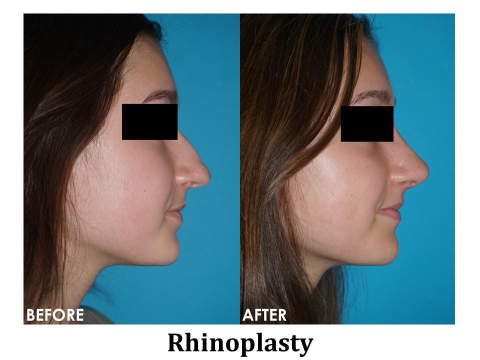 Rhinoplasty Before & After Image