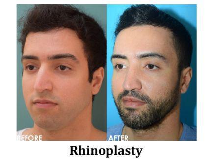 Rhinoplasty Before & After Image