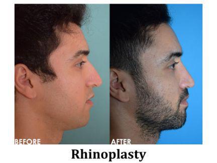 Rhinoplasty Before & After Image