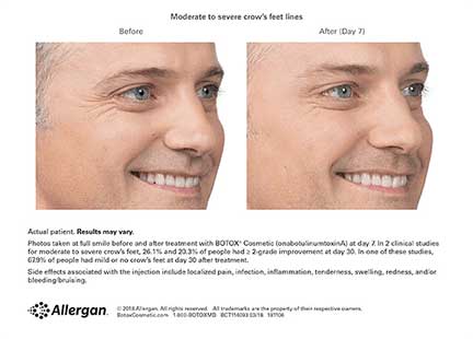 Botox Before & After Image