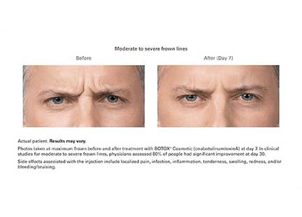 Botox Before & After Image